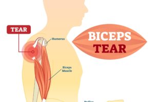 Bicep Tears: Understanding, Preventing, and Healing