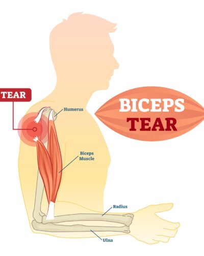 Bicep Tears: Understanding, Preventing, and Healing